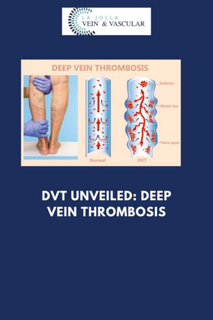 (2023) How To Code DVT ICD 10 List With Codes & Guidelines