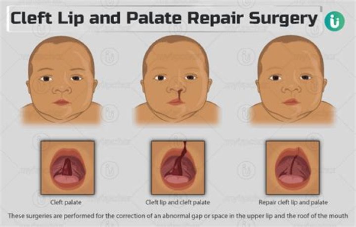 Cleft Palate Revision Surgery in India All That You Wanted to Know