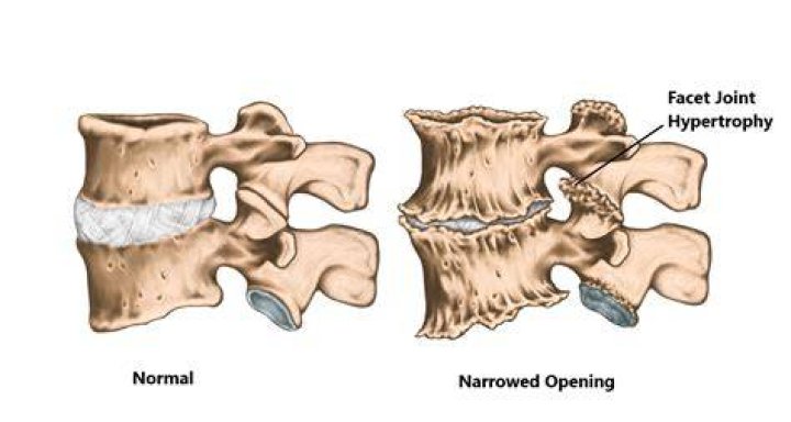 Facet Hypertrophy