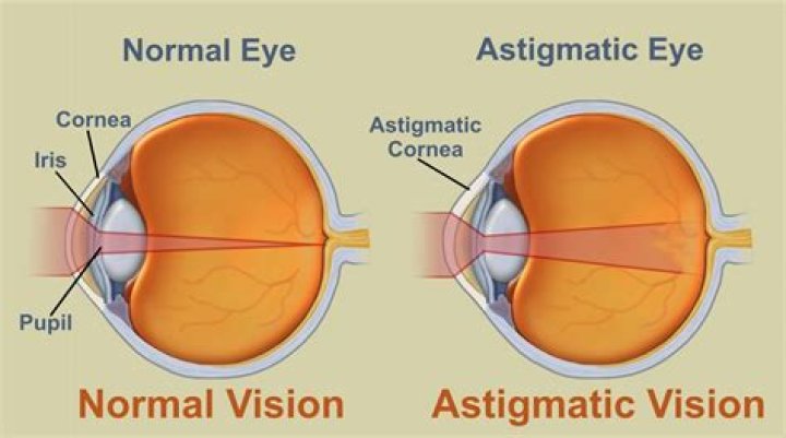 Vision Source New Westminster What is Astigmatism?