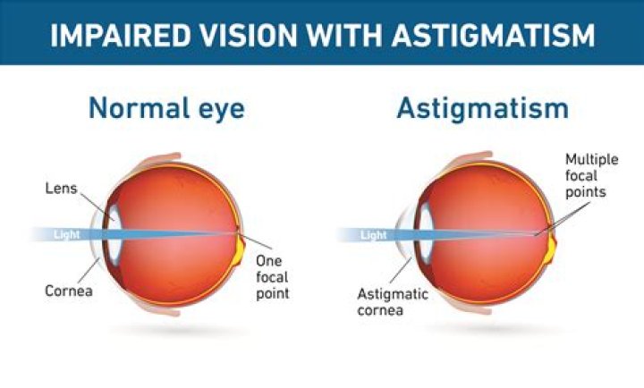 What Is Astigmatism & Everything You Need to Know &mdash; UNIQSO